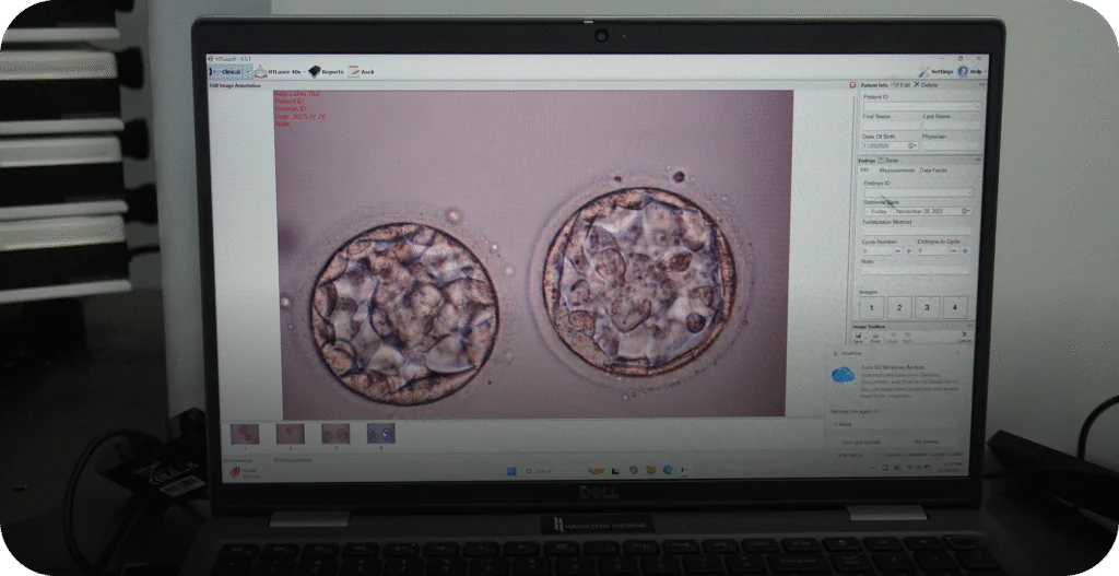 Close-up view of a laptop screen displaying two high-quality blastocyst embryos in the IVF lab. - AAS Fertility