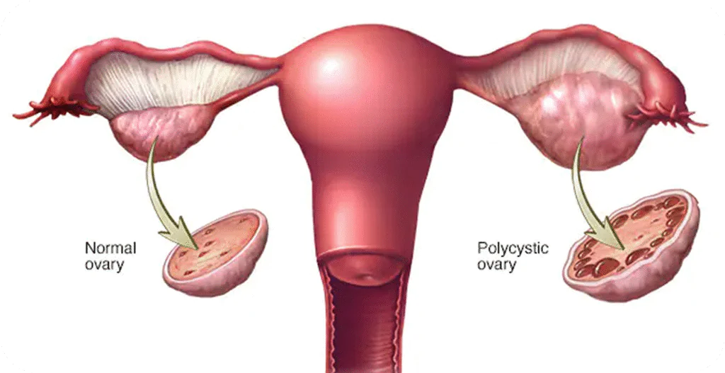 Is It Possible to Get Pregnant With PCOS? - AAS Fertility & IVF Center