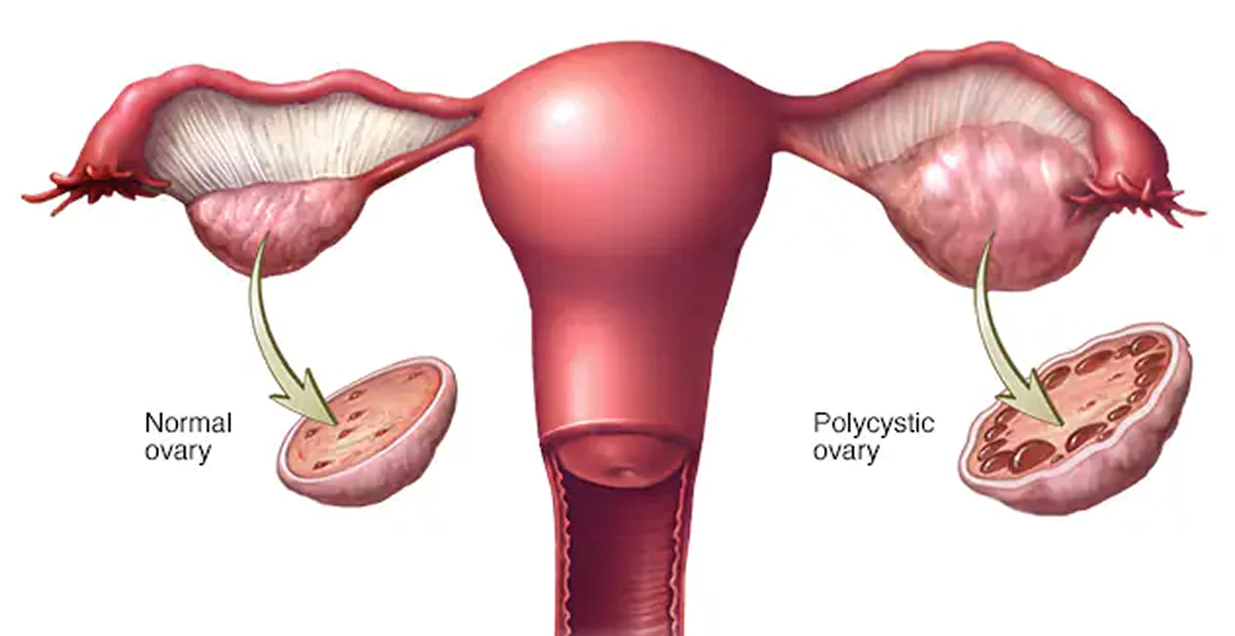 Is It Possible to Get Pregnant With PCOS? - AAS Fertility & IVF Center
